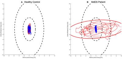 Sham-Controlled Study of Optokinetic Stimuli as Treatment for Mal de Debarquement Syndrome